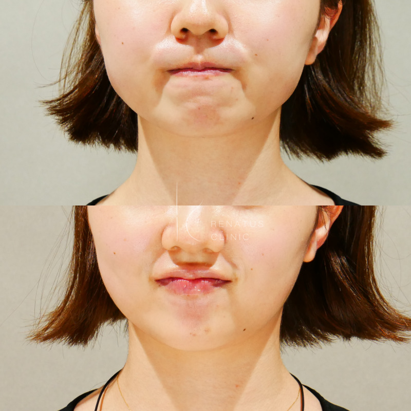 顎ボトックス症例写真