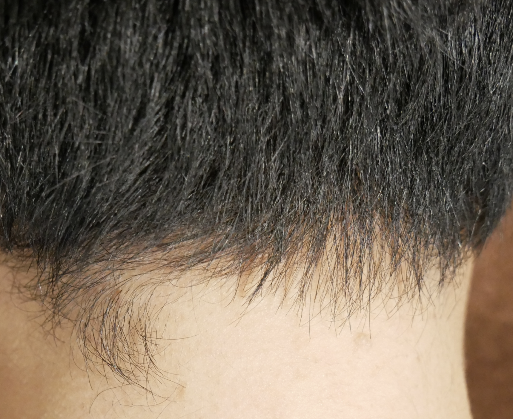 生え際を整える髪の毛の医療脱毛の痛みは 回数は 料金は 東京都港区田町 銀座 品川で医療脱毛するならrenatus Clinic レナトゥスクリニック