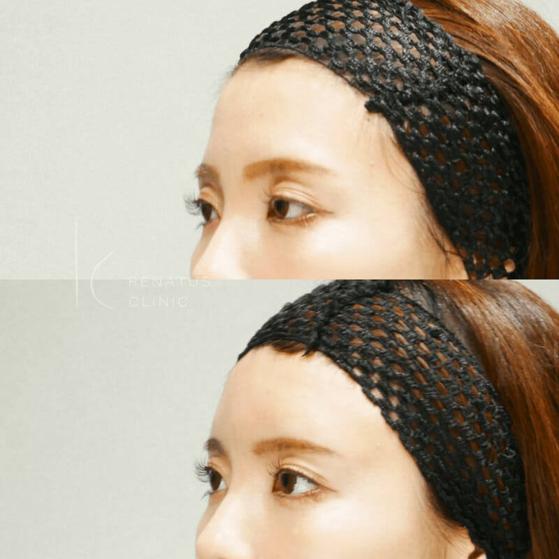 額ヒアルロン酸ボリューマ