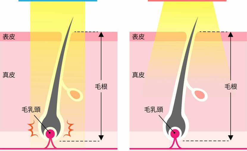 医療脱毛とエステ脱毛 美容脱毛の効果 機械 痛み 回数 価格 スタッフの違いまとめ