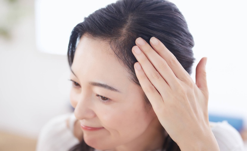 女性の薄毛治療