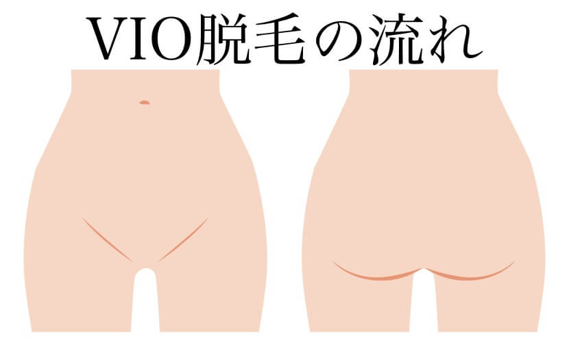 VIO脱毛の流れ