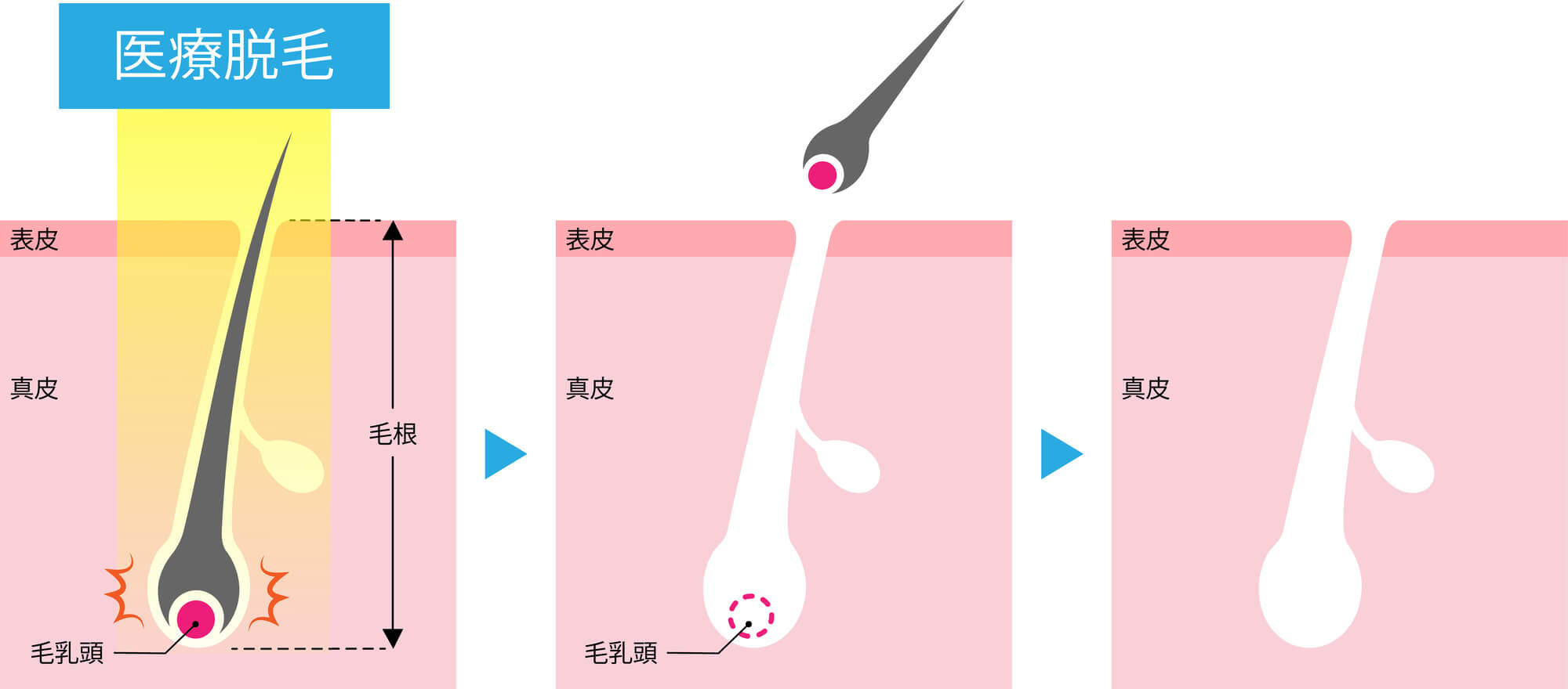 医療脱毛　しくみ　断面図