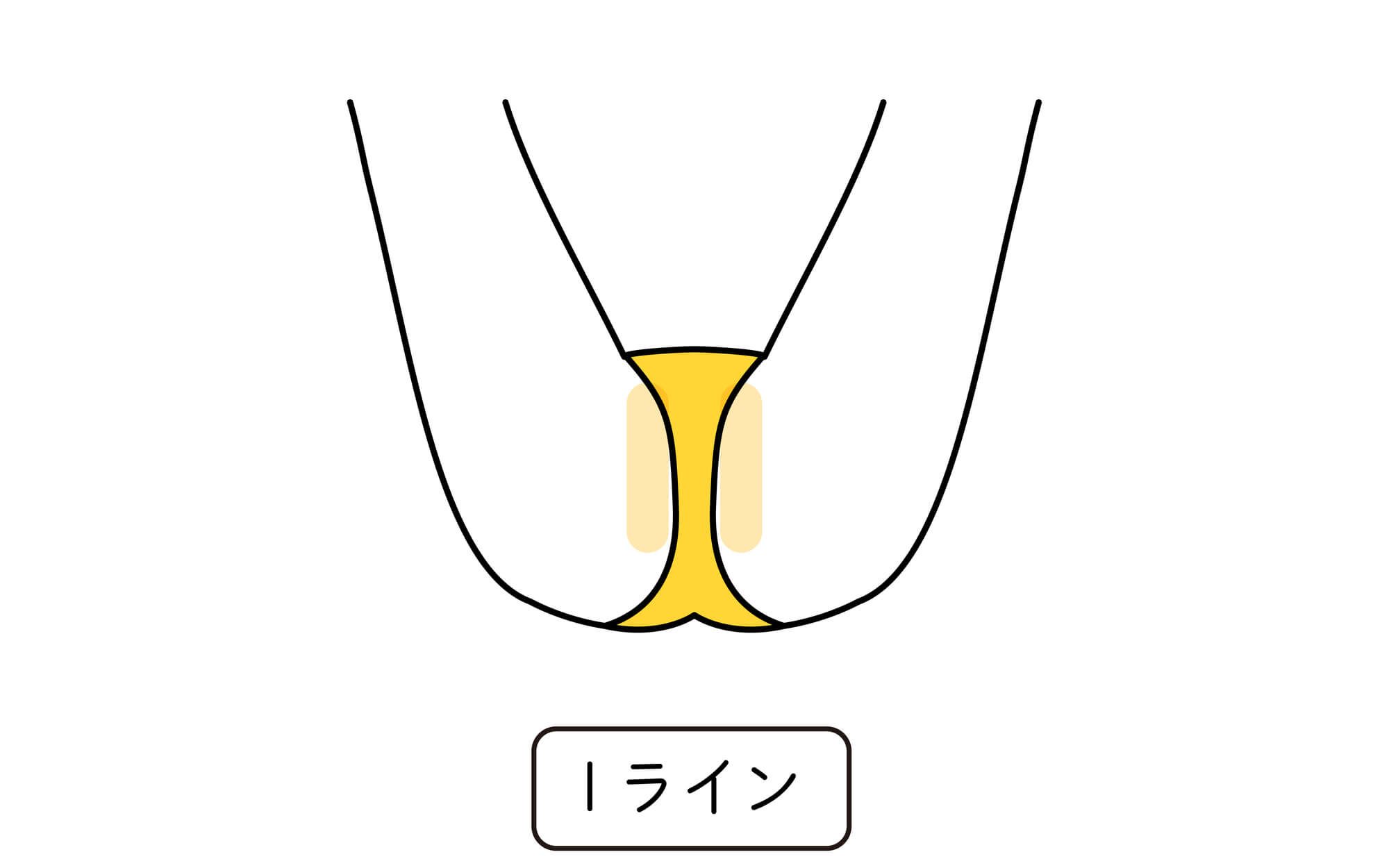 Iラインの脱毛部位を示したイラスト