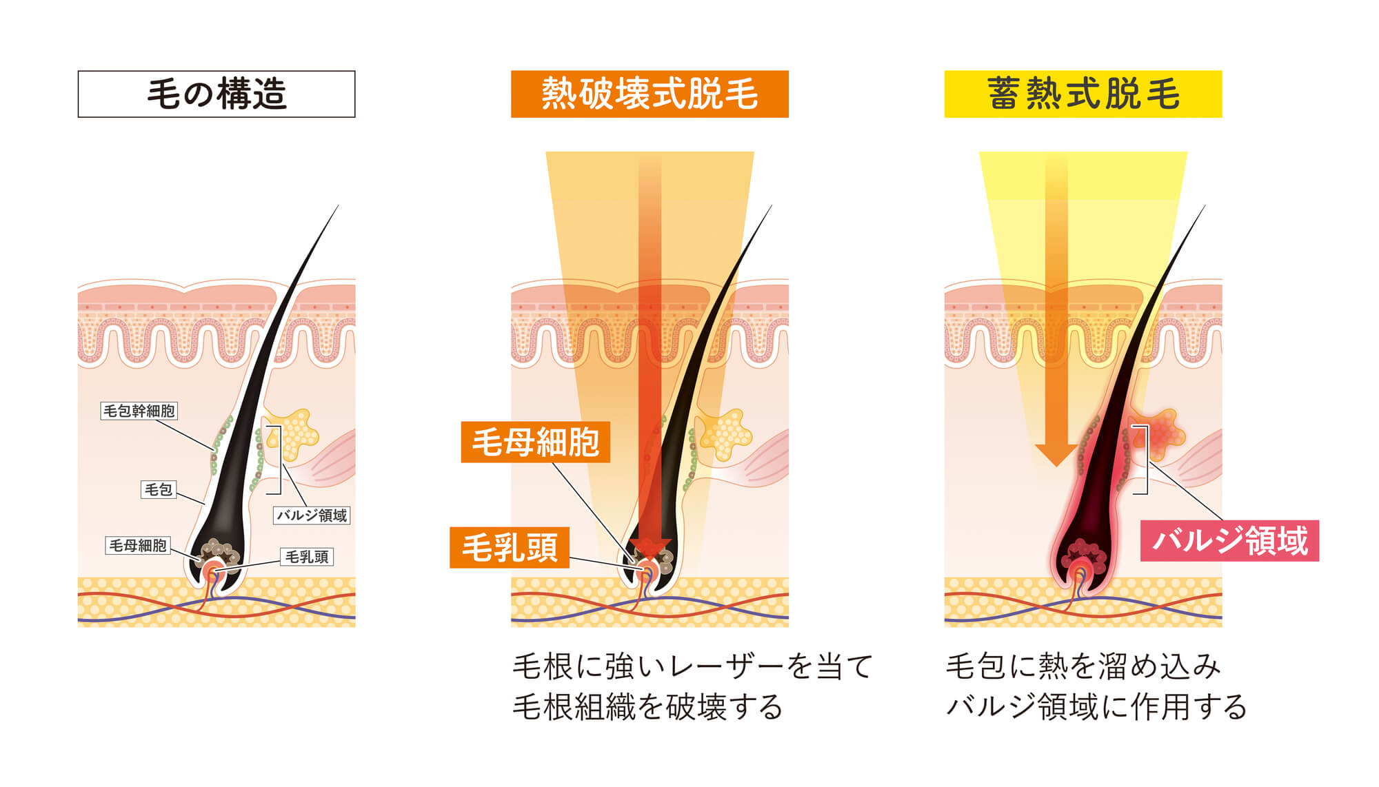 肌の断面図。肌と毛の状態を診察して照射条件を検討します