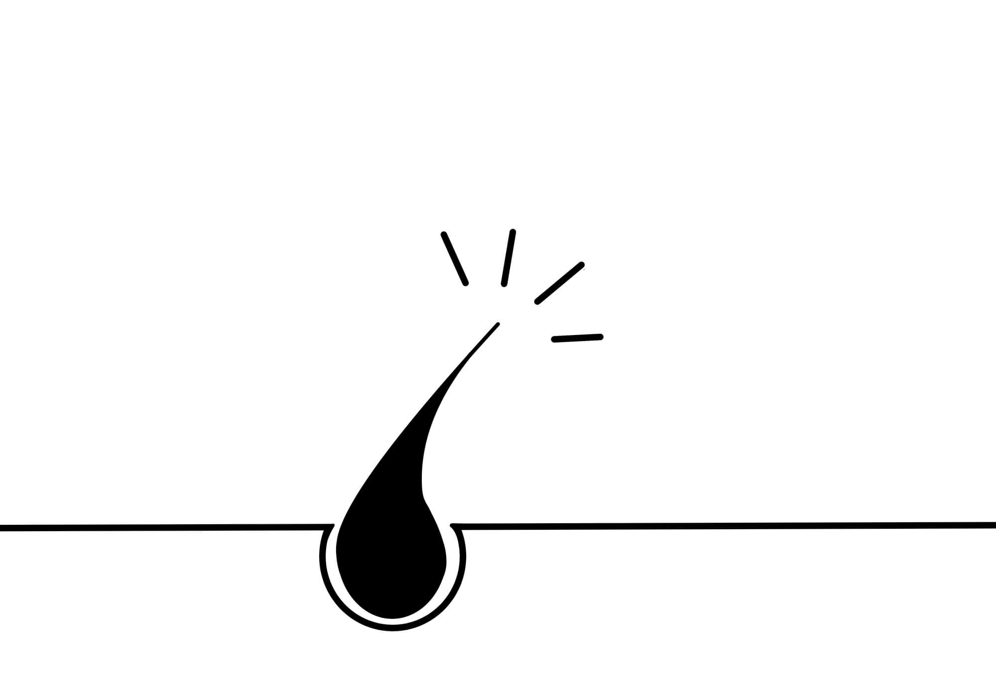 一生毛が生えてこないは嘘!?医療脱毛の10年後は? 7 また生えてくる