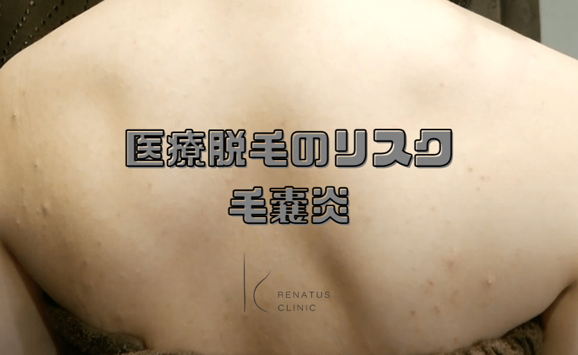 医療脱毛のリスク 毛嚢炎