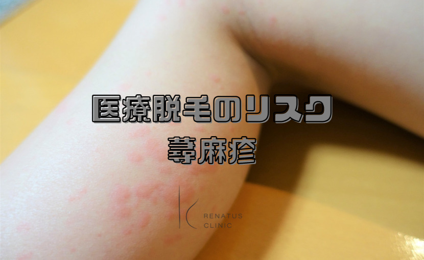 医療脱毛のリスク 蕁麻疹