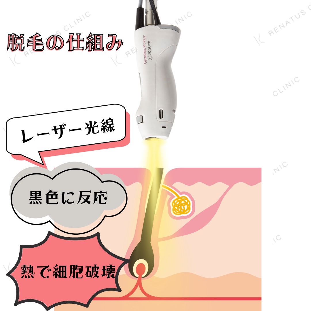 医療脱毛 19 脱毛の仕組み