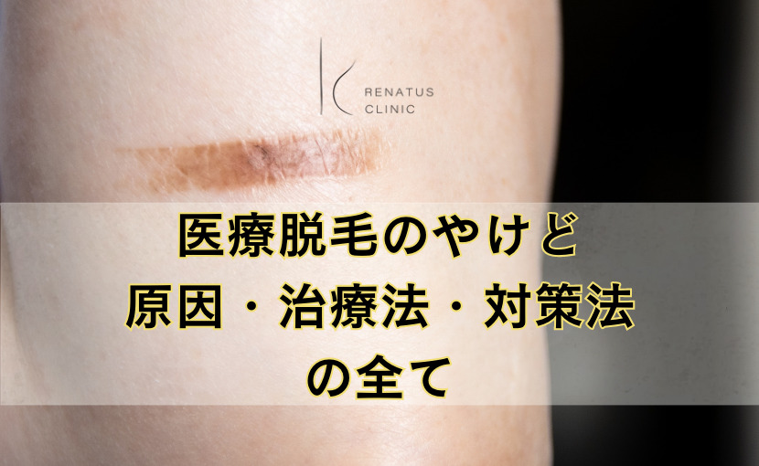 医療脱毛のやけど 原因・治療法・対策法
