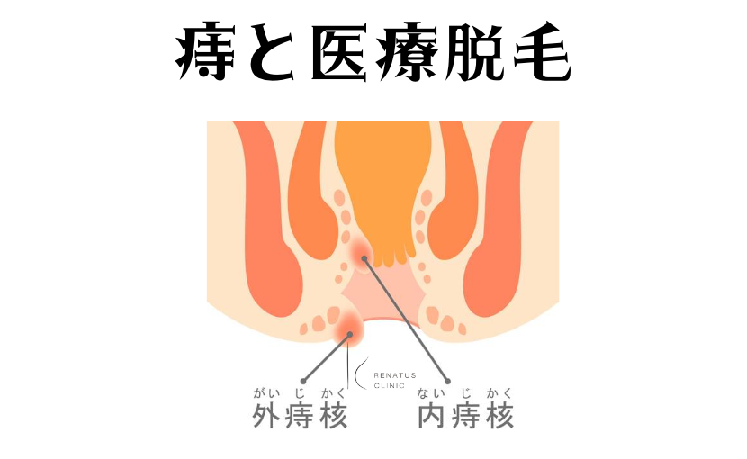 痔と医療脱毛