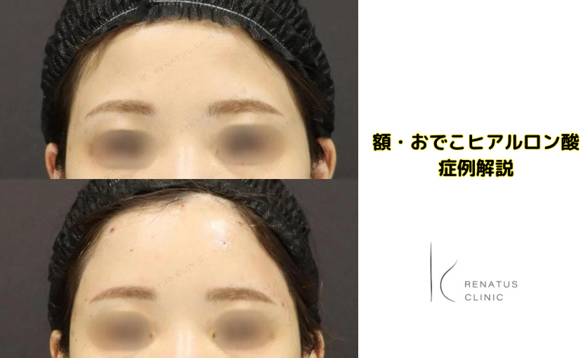 額ヒアルロン酸解説