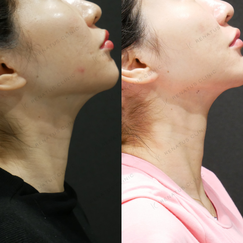 首のシワヒアルロン酸症例2