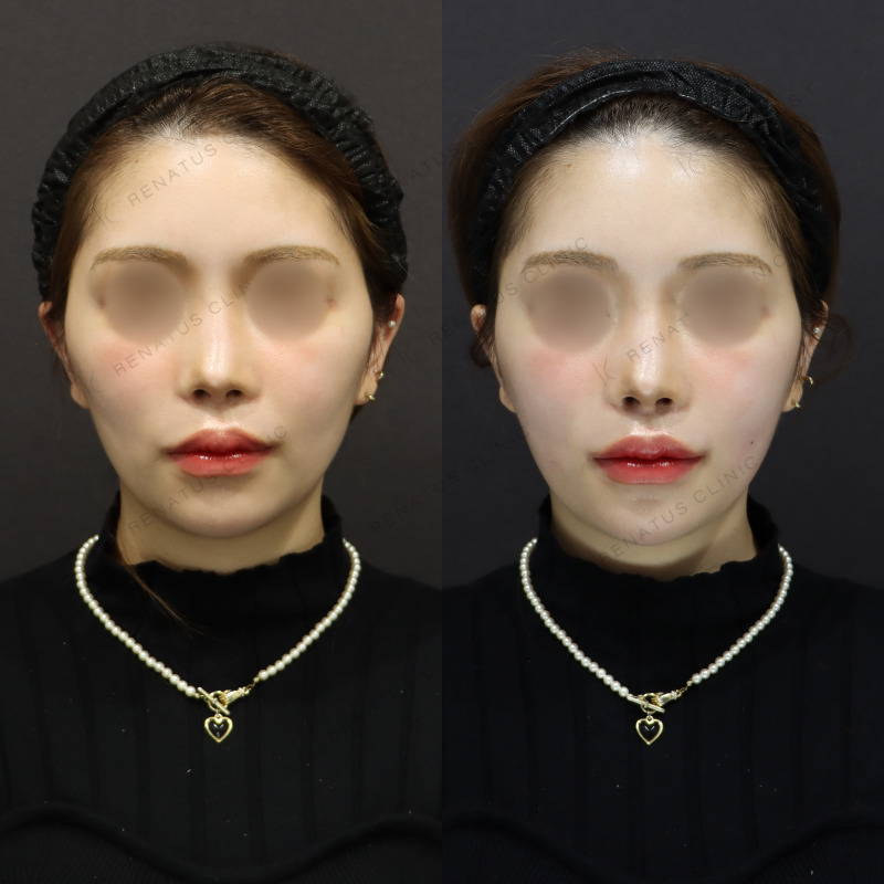 頬の凹み頬コケへのヒアルロン酸注入 3 頬コケ症例写真1