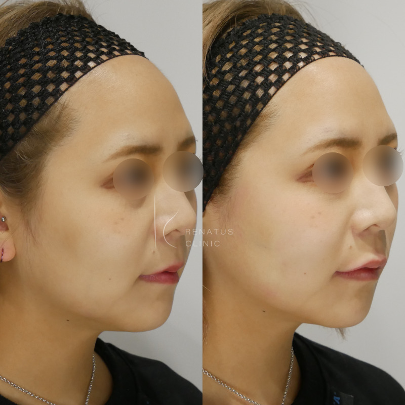 カスタマイズヒアルロン酸