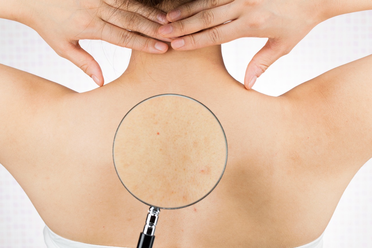 背中上下医療脱毛