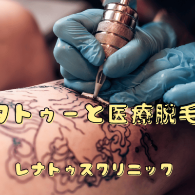 タトゥー脱毛