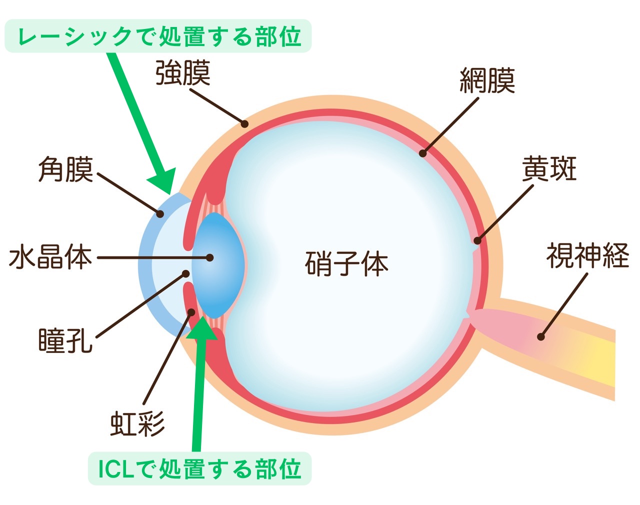 眼の解剖とICL・レーシックで処置する部位