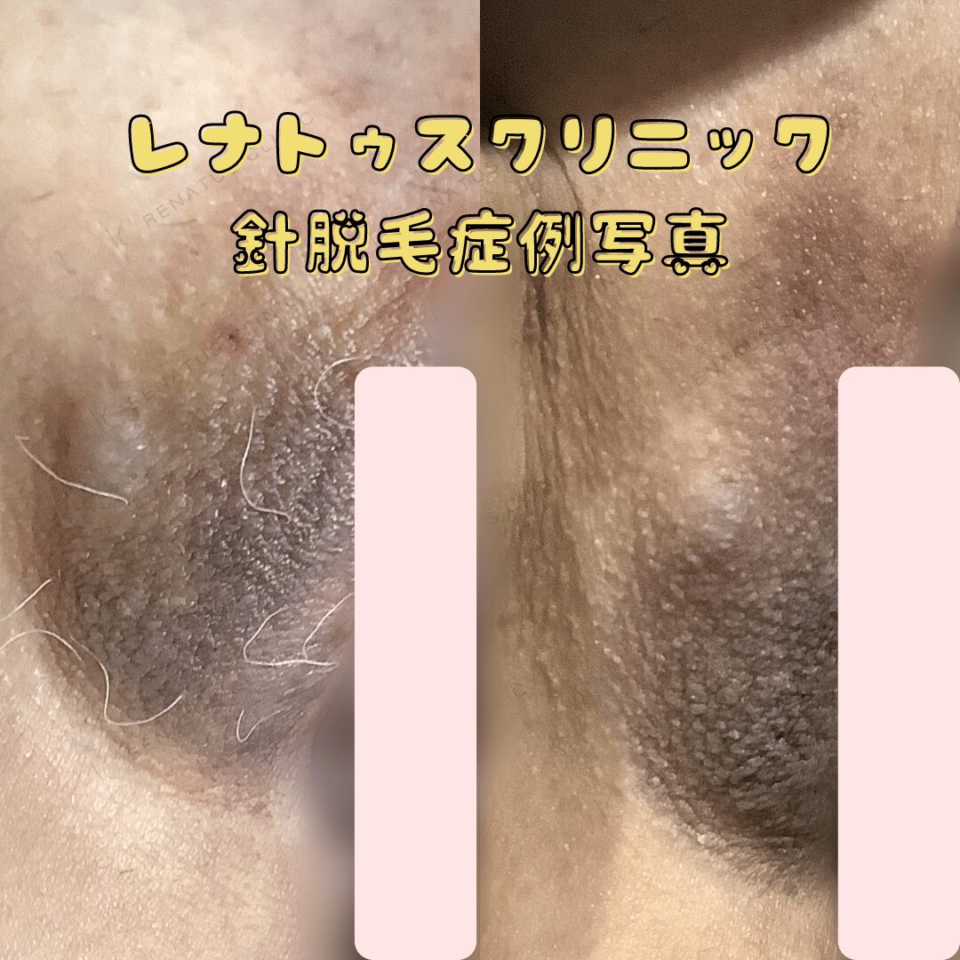 レナトゥスクリニック 針脱毛症例写真