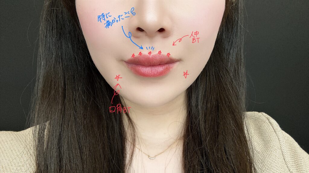 唇ヒアルロン酸カウンセリング症例写真ボトックス人中口角
