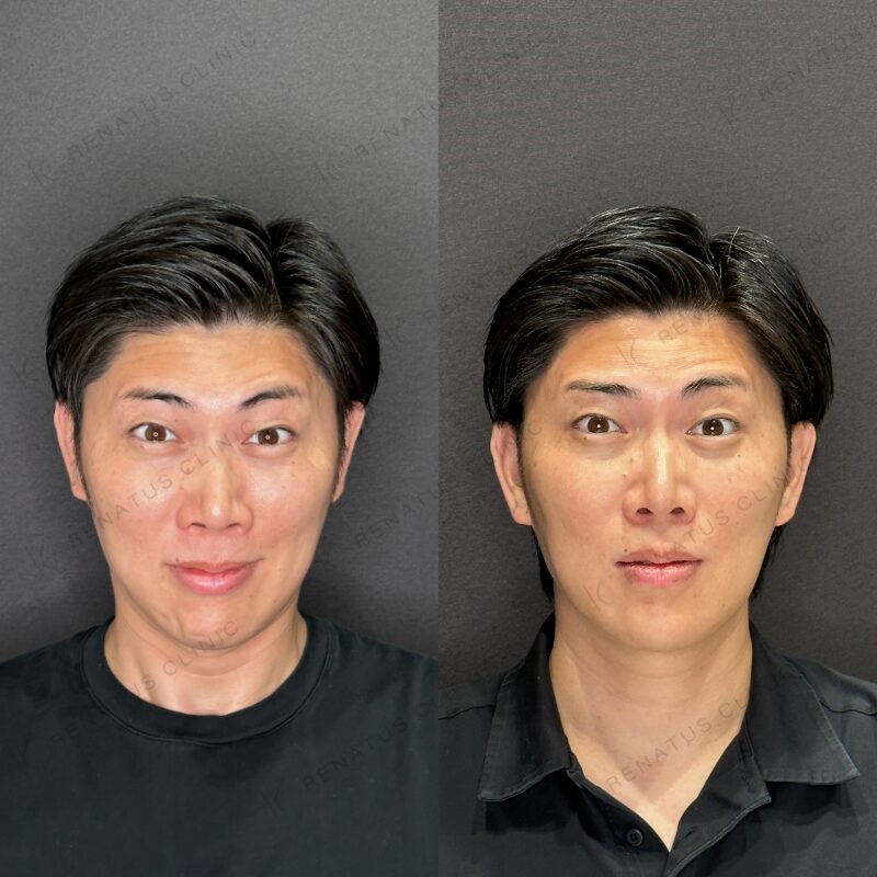 額ボトックスの施術前と施術後（当院の症例）