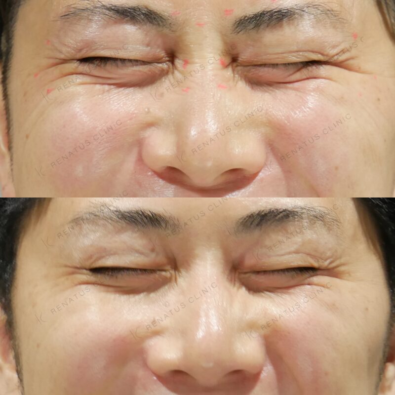 目尻目の下鼻根眉間鼻背ボトックス症例写真