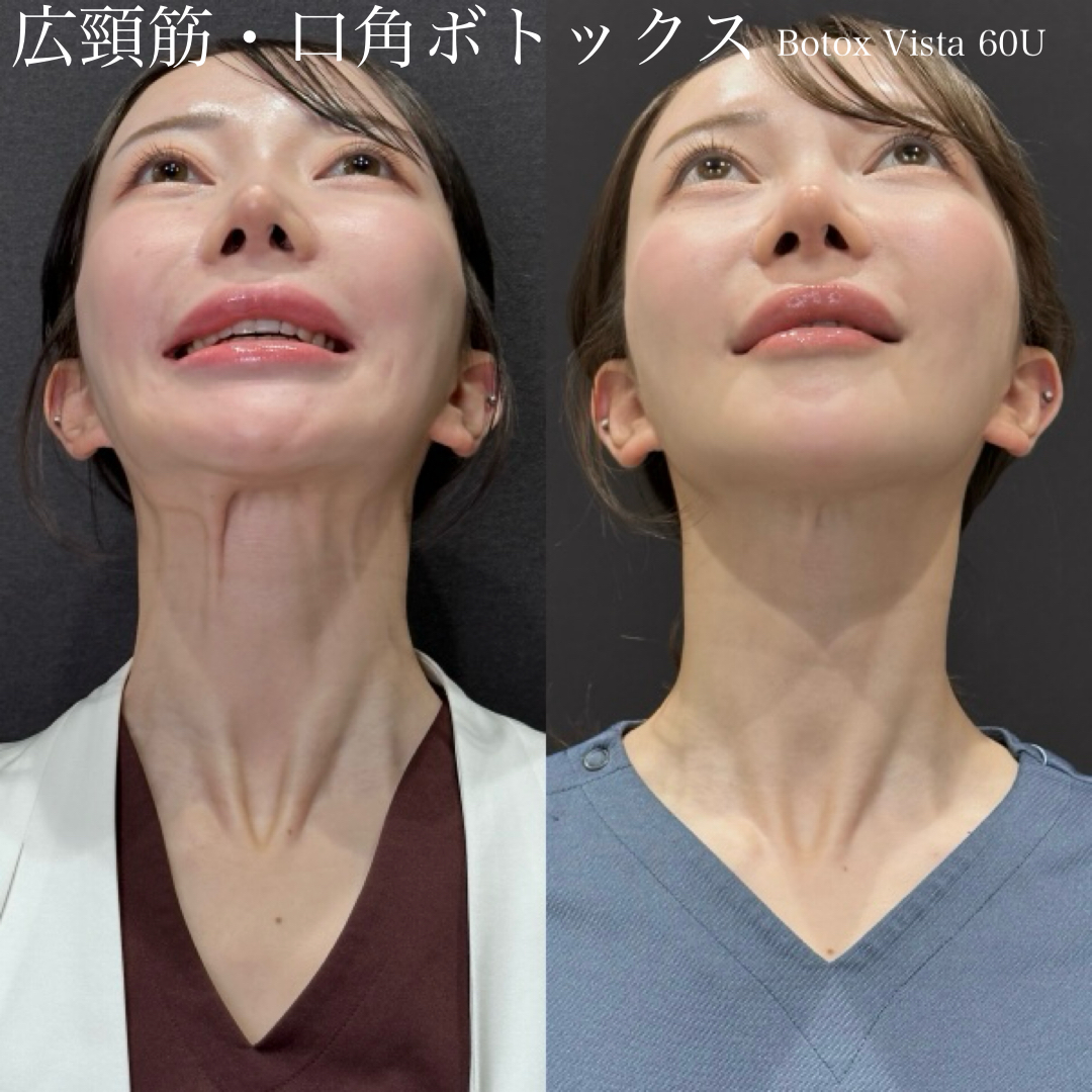 広頚筋・口角BT Botox vista 60U 上向 症例写真