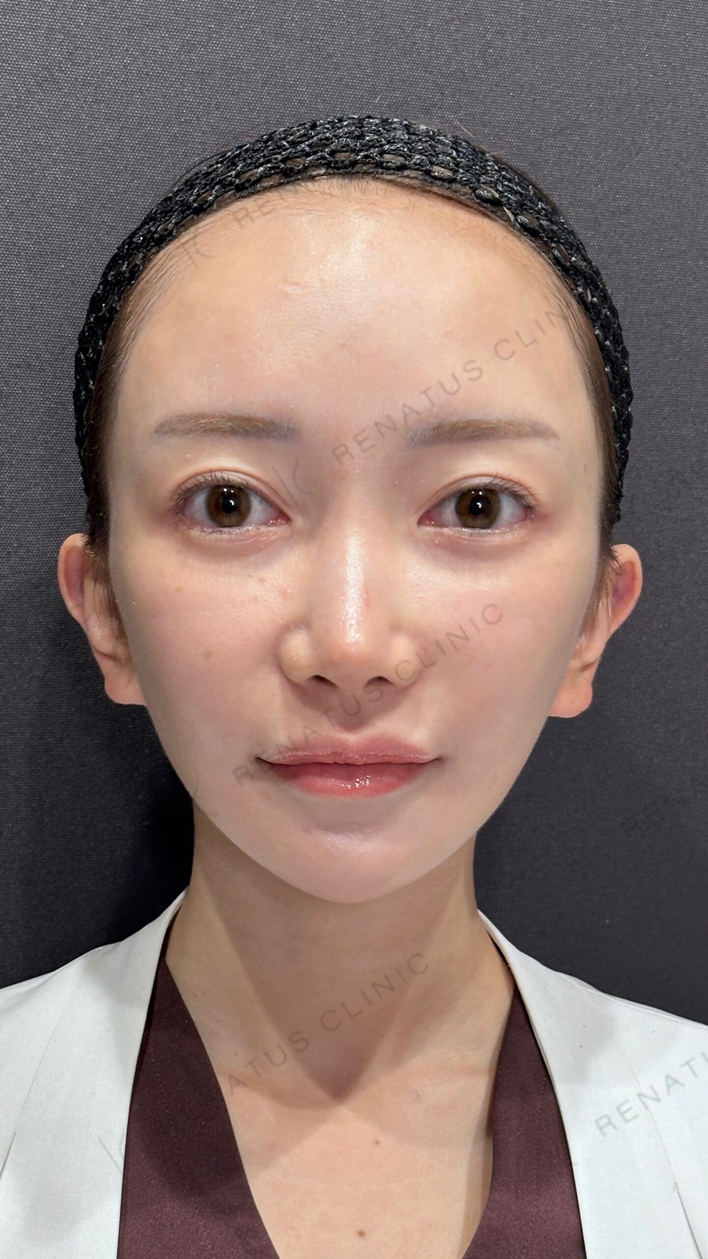 リジュランとスネコスの施術前（メイクなし）