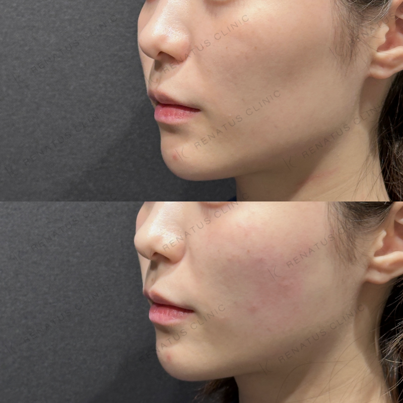 ゴルゴラインヒアルロン酸注入なら レナトゥスクリニック 2 ゴルゴラインの原因と治療