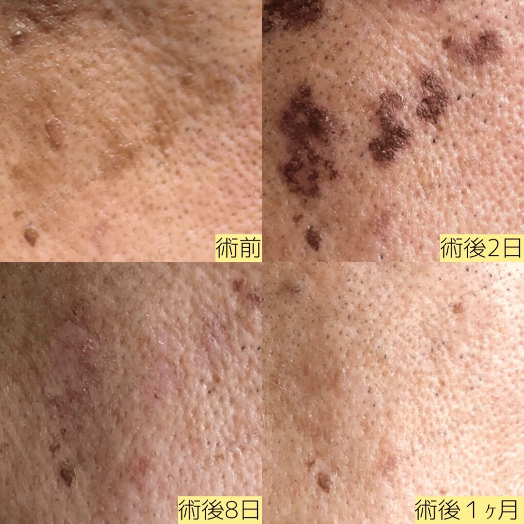 シミスポット直後、2日、8日、1ヶ月後の経過写真