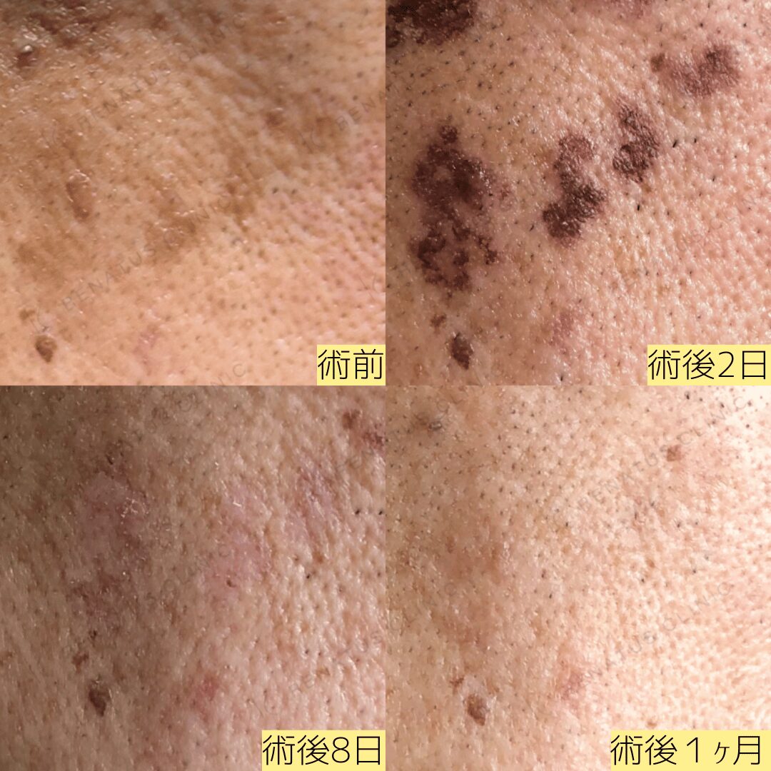 Picowayによるシミ治療。730nmの波長を使用。