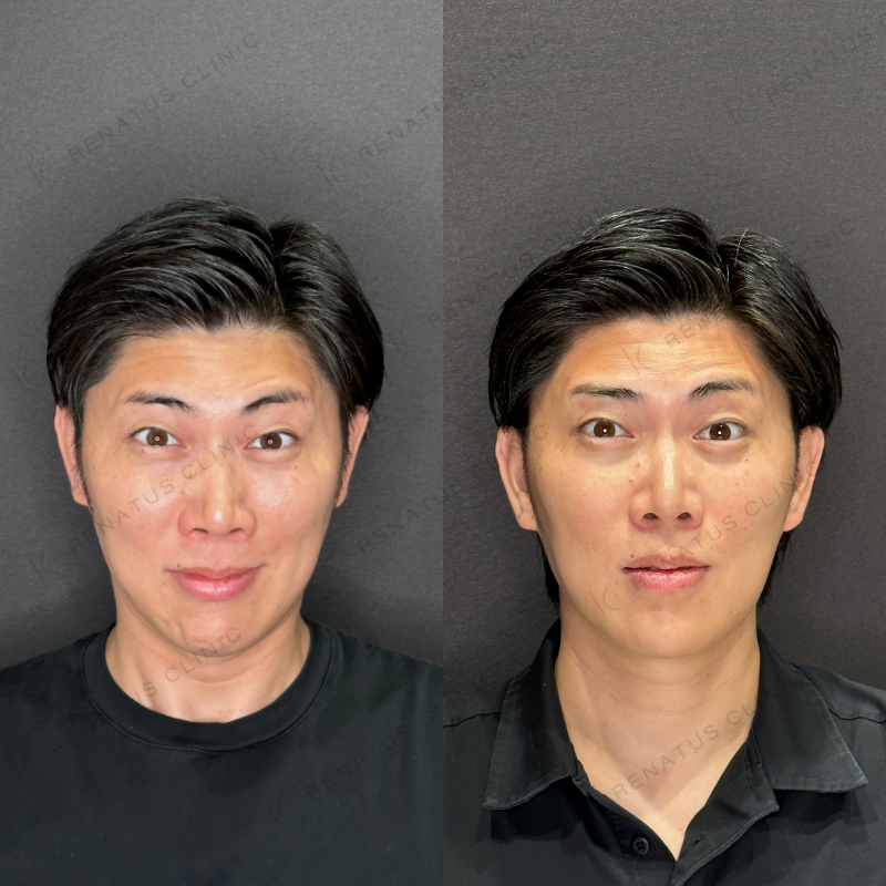 福岡天神で安い料金¥2200で上手いおすすめで人気の名医でボトックス注射を受ける方法 2 額ボトックス