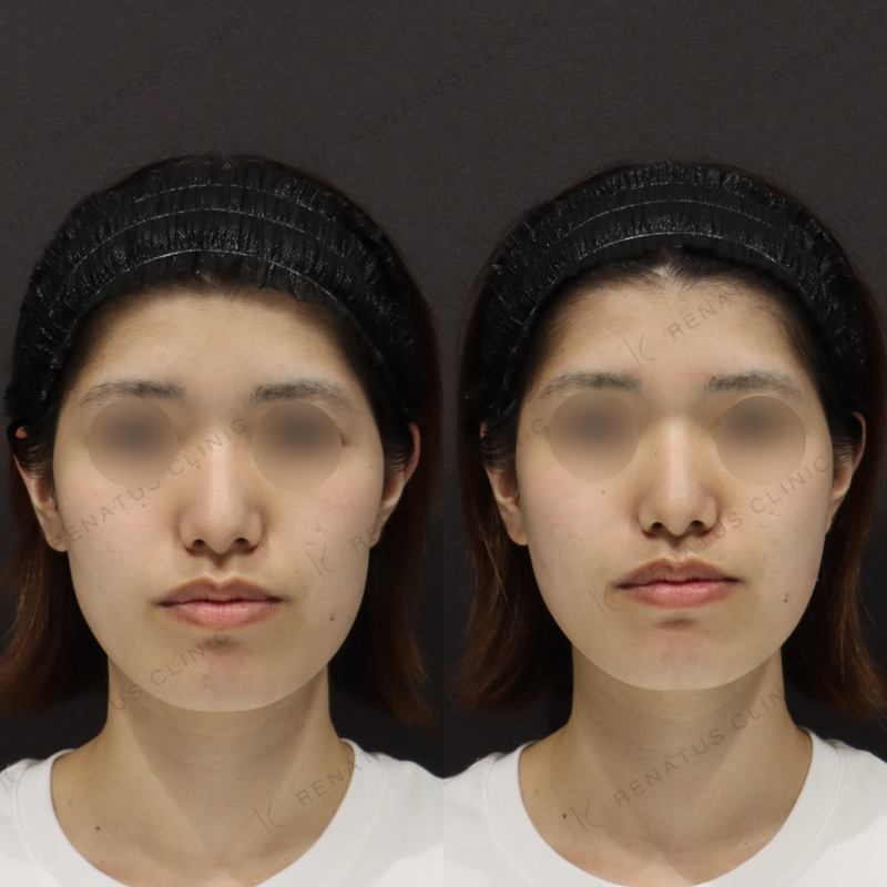 新宿頬コケヒアルロン酸症例