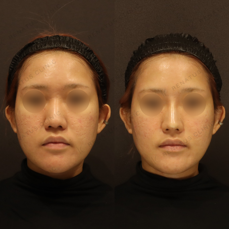 新宿鼻翼基部ヒアルロン酸症例