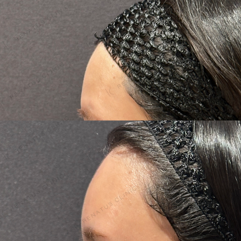 新宿額ヒアルロン酸症例