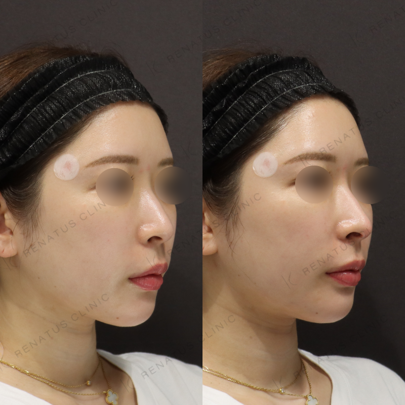 新宿鼻ヒアルロン酸症例