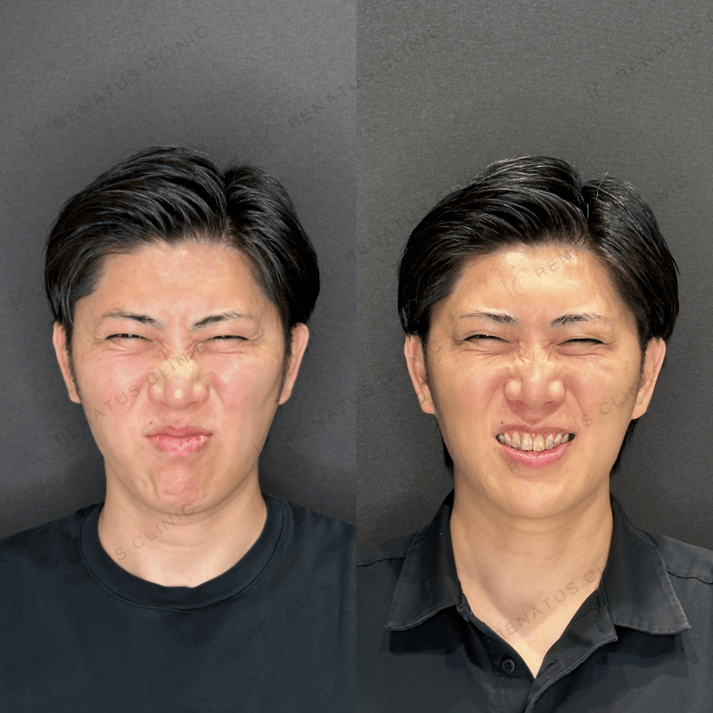 鼻根・鼻背ボトックスの施術前と施術後（当院の症例）