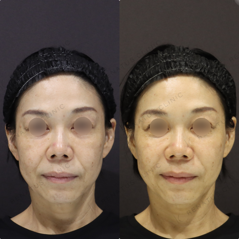 新宿ボリューマリフトヒアルロン酸症例