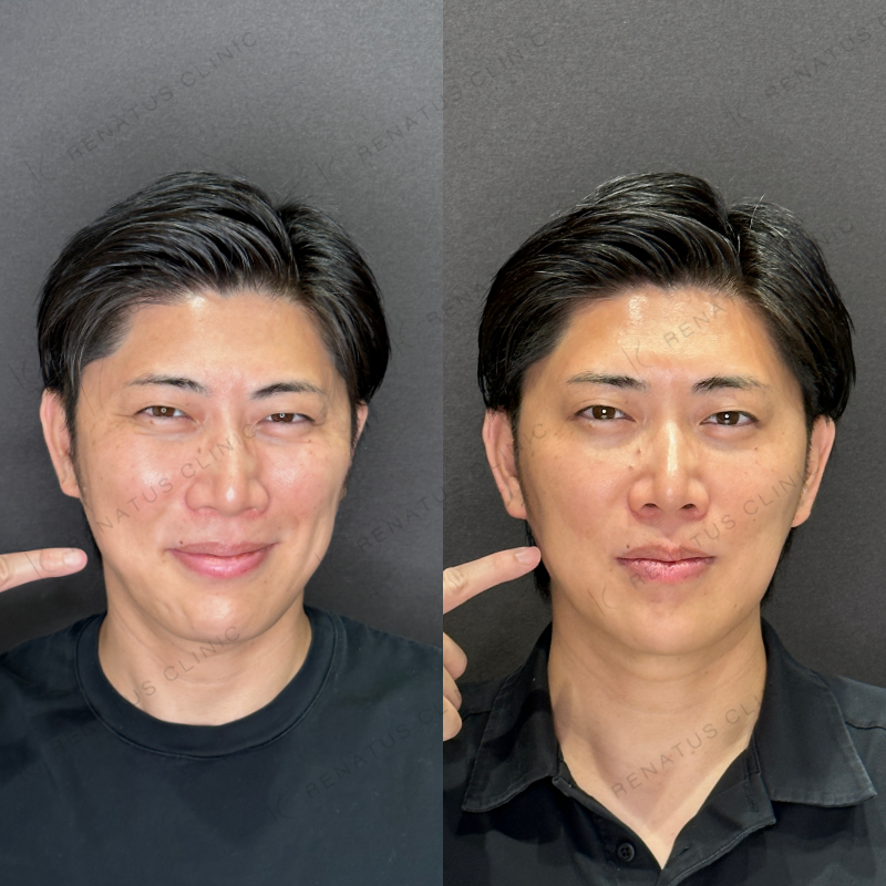 福岡天神で安い料金¥2200で上手いおすすめで人気の名医でボトックス注射を受ける方法 3 エラボトックス