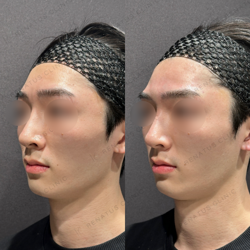 新宿眉間眉上ヒアルロン酸症例