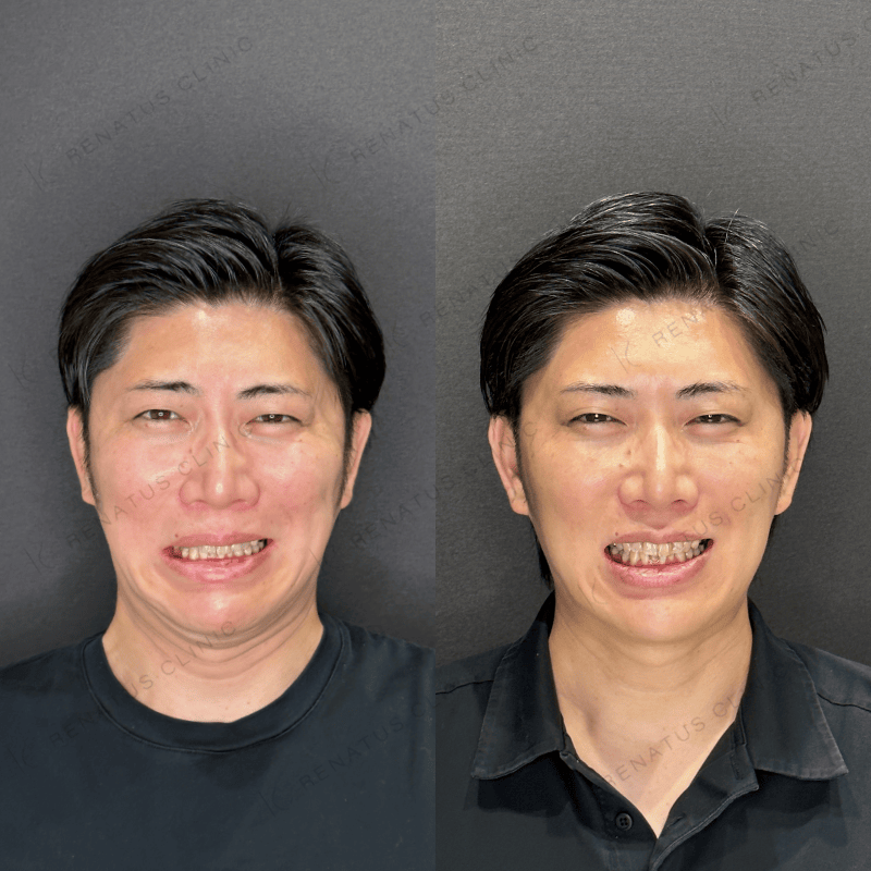 口角ボトックスの施術前と施術後（当院の症例）
