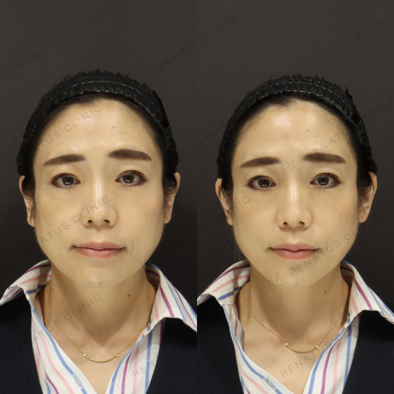 新宿立ち耳ヒアルロン酸症例