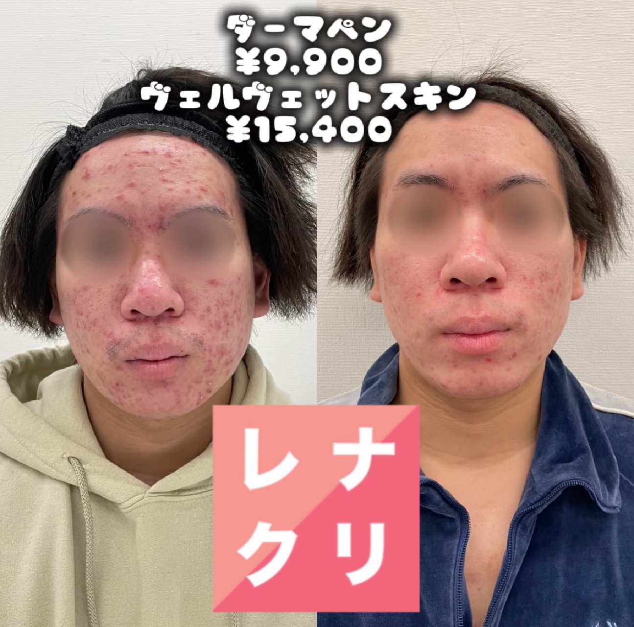仙台ダーマペンヴェルベットスキンうまい安い効果あり