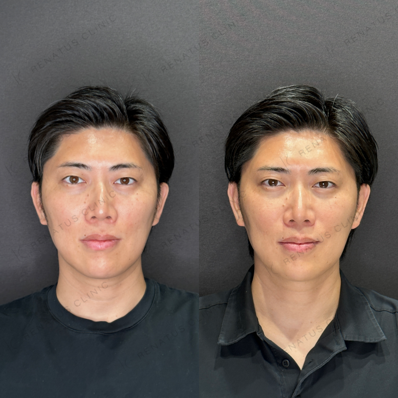 福岡天神で安い料金¥2200で上手いおすすめで人気の名医でボトックス注射を受ける方法 5 マイクロボトックス