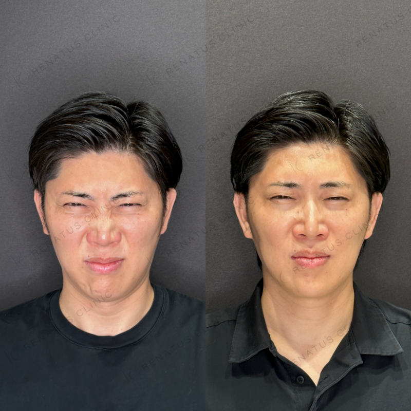 福岡天神で安い料金¥2200で上手いおすすめで人気の名医でボトックス注射を受ける方法 4 眉間ボトックス