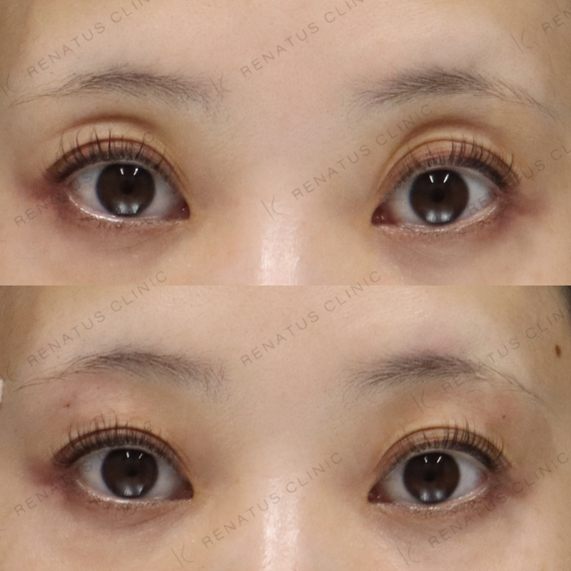 新宿目の上ヒアルロン酸症例