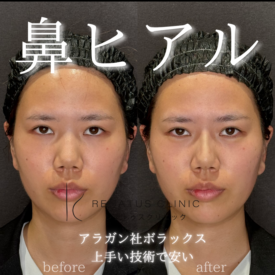 新宿で上手い安い鼻ヒアルロン酸注射ならレナトゥスクリニック新宿院