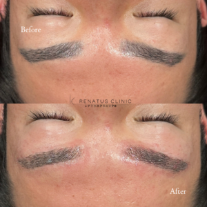 東京で安い上手いおすすめのアートメイク除去