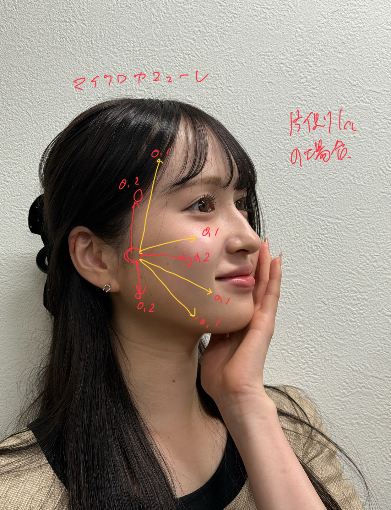 プルリアルデンシファイ全顔何cc