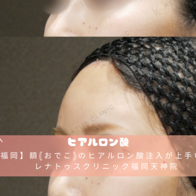 【福岡】額(おでこ)のヒアルロン酸注入が上手い安いレナトゥスクリニック